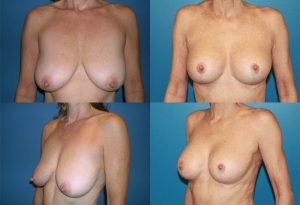Chirurgie esthetique réduction mamelon avant après