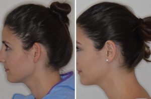 Chirurgie esthétique de l'oreille 