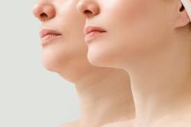 Jawline contouring par lipofilling : injection de graisse remodeler les contours du visage