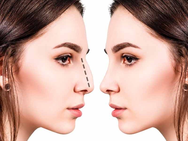 Chirurgie Esthétique du nez