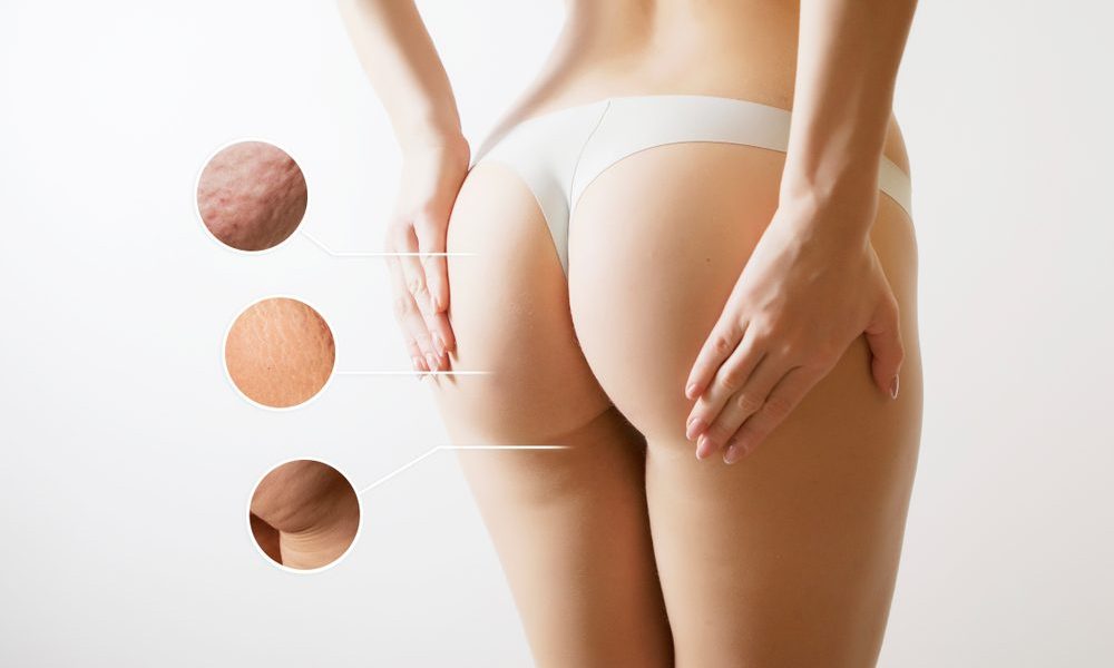 lipofilling fessiers prix Tunisie