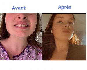 Jawline contouring par lipofilling 