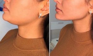injection de graisse visage 