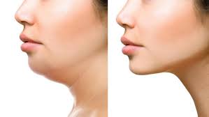 Jawline Liposuccion : liposuccion de la mâchoire