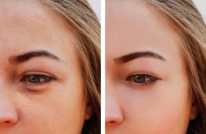 Nanofat tunisie réjuvénation du visage par lipofilling
