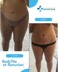 BodyTite Tunisie