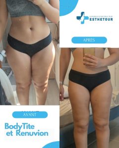 BodyTite et Renuvion en Tunisie 