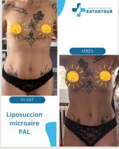 prix liposuccion PAL MicroAire Tunisie