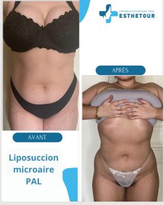 liposuccion PAL MicroAire tunisie