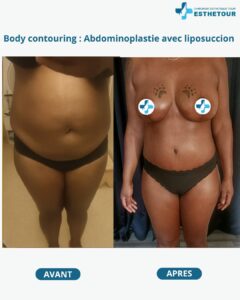 Abdominoplastie avec Liposuccion 