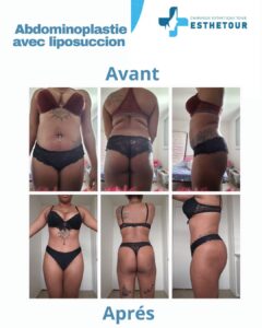 Body Contouring : Abdominoplastie 