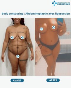 Body Contouring : Abdominoplastie avec Liposuccion 