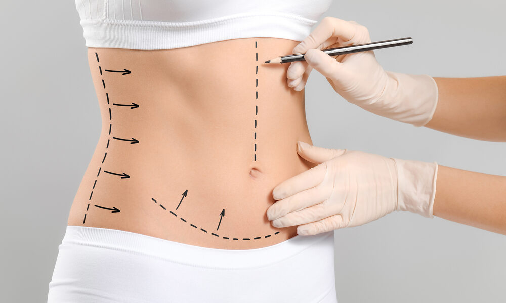 abdominoplastie Fleur de Lys
