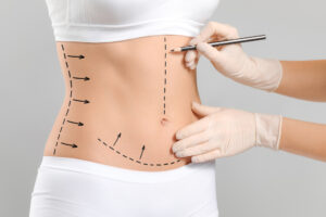 abdominoplastie Fleur de Lys