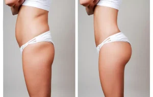 iposuccion avec abdominoplastie