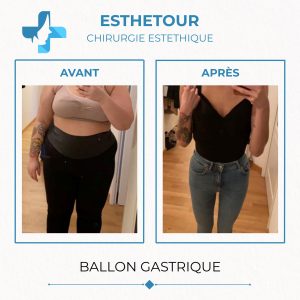 Photos avant/après de ballon gastrique