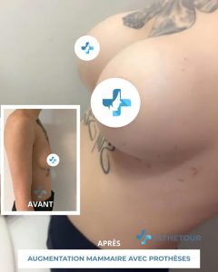 augmentation mammaire prix tunisie