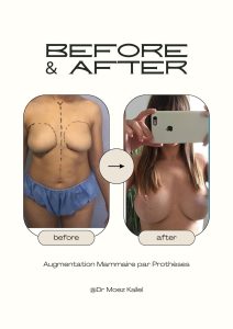 implants mammaire avant après
