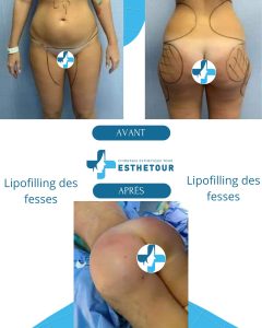 Augmentation des Fesses en Tunisie BBL & Implants Fessiers