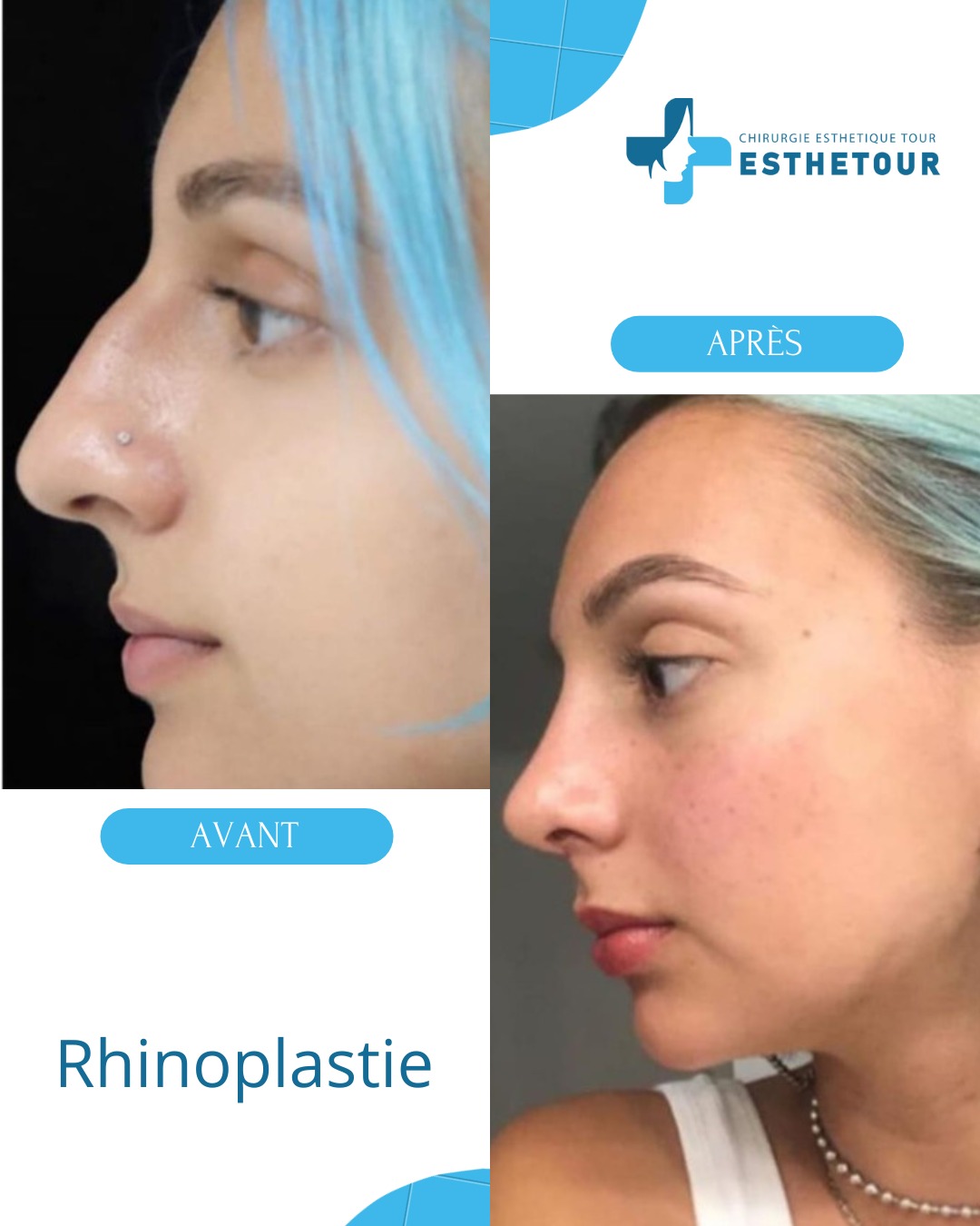 Résultat rhinoplastie Tunisie avant après : correction du nez par chirurgie esthétique réalisée par Esthetour — profil de face et 3/4, nez harmonieux naturel